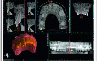 Micro-endodontie guidée : la solution face aux minéralisations pulpaires ?